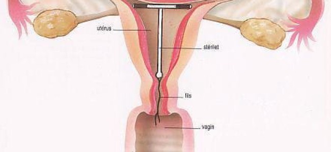Steriletul, o metoda contraceptiva clasica Steriletul, o metoda contraceptiva clasica