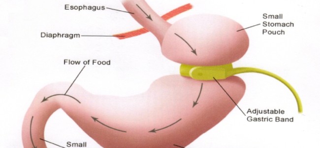 Gastric banding: inel gastric ajustabil Gastric banding: inel gastric ajustabil