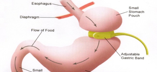 Gastric banding: inel gastric ajustabil