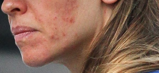 Acneea afecteaza si femeile de varsta mijlocie. Metode eficace de tratament Acneea afecteaza si femeile de varsta mijlocie. Metode eficace de tratament