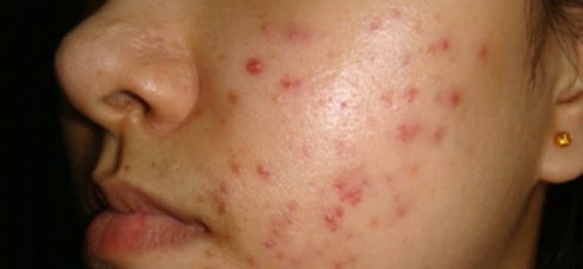 Tratamentul cu isotretinoin (Roaccutane) in acneea severa