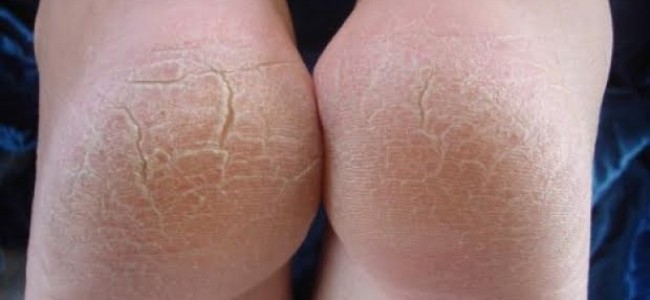 Calcaie crapate? Combina aceste doua ingrediente si scapi de problema in doar o zi! Calcaie crapate? Combina aceste doua ingrediente si scapi de problema in doar o zi!